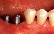 IMPLANTES APLICADOS NA BOCA