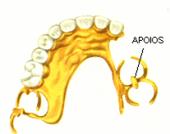 PRTESE ESQUELTICA SUPERIOR